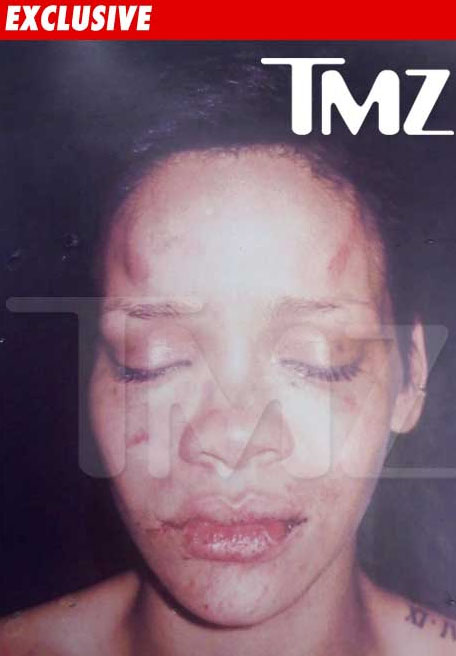 makeup bruises. Bruised Rihanna